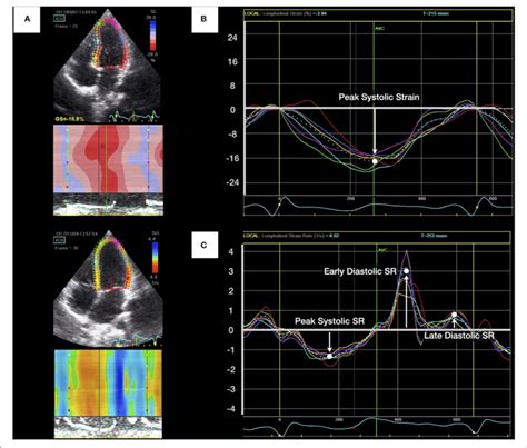 lv longitudinal strain|time to peak longitudinal strain.